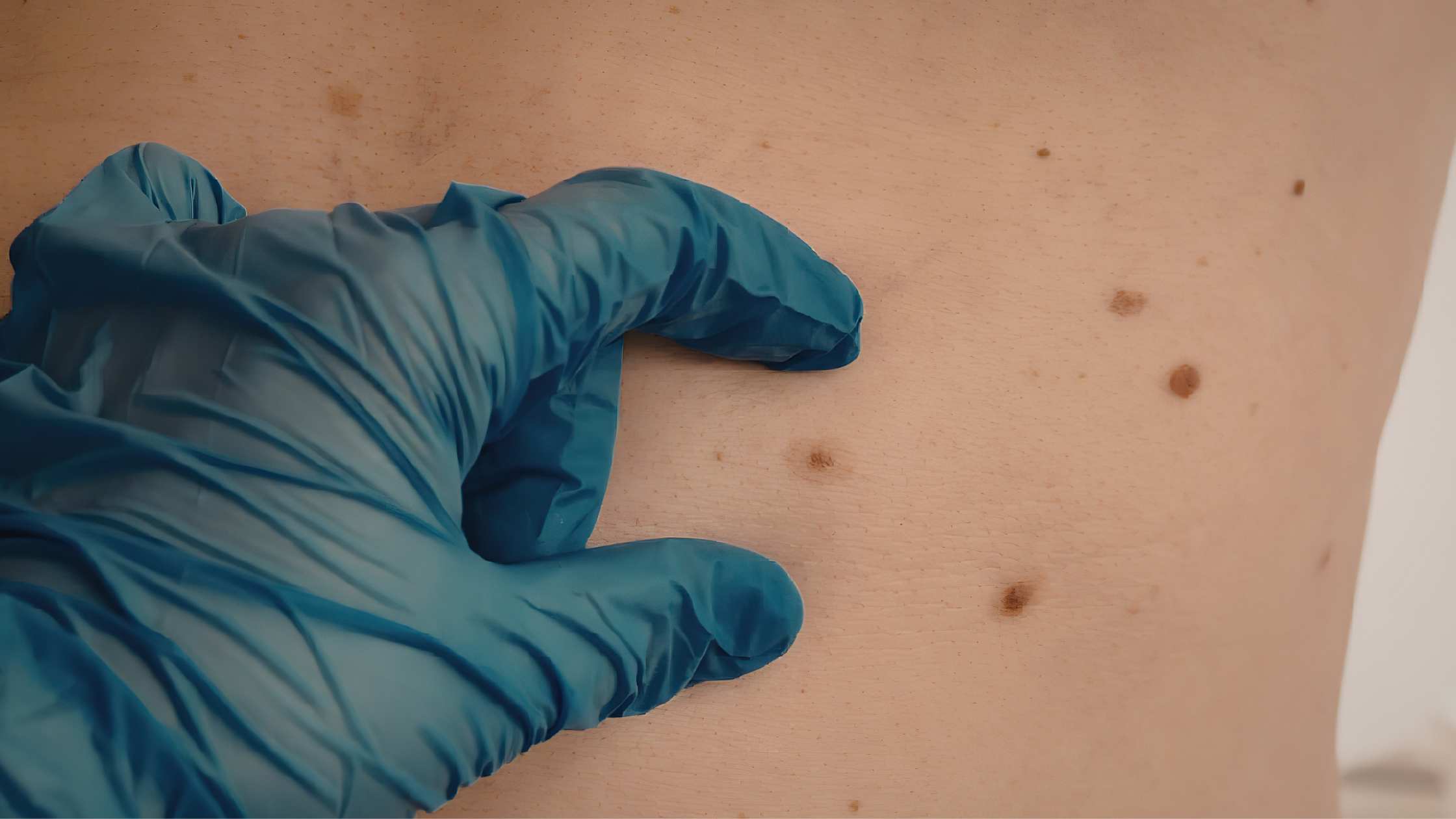 Behandeling-moedervlekken