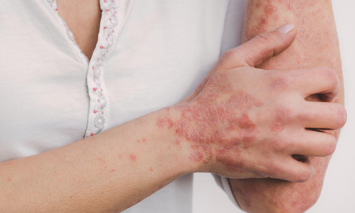 header-behandeling-psoriasis-website.